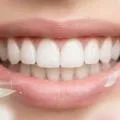 تجميل الأسنان